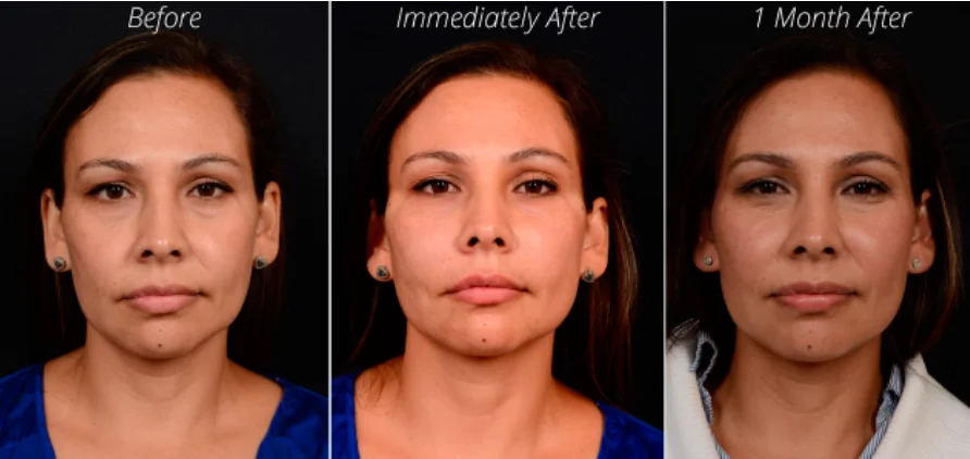 pdo thread brow lift before and after