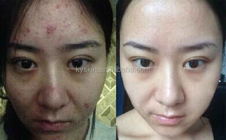 does witch hazel remove acne scars