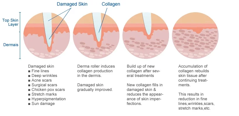 0.25 mm Needle Size   0.25mm needle size is not really intended to treat wrinkles and scars. It is strictly used for boosting topical skin care product absorption by 10,000 times. It can also thicken your top skin layer called “epidermis”.  0.5 mm Needle Size   0.5 mm can treat fine lines, shallow scarring, mild stretchmarks, hyper pigmentation and sun damage. It also boosts absorption of topical products by 10,000 times. It can also thicken your top skin layer called “epidermis”. You can use 0.5 mm once per week. It is less painful than longer microneedles and have shorter recovery time. The usage of numbing cream is usually not necessary.   0.75 to 1.0 mm Needle Size   0.75 to 1.0 mm can treat hyper-pigmentation, sun damage, shallow to deep wrinkles/scars and stretchmarks.   1.5 to 3.0 mm Needle Size   1.5 to 3.0 mm rollers can treat SEVERE scarring or stretch marks. It is safer to use them on your body than on your face. These rollers are commonly used for treating burned scars..png