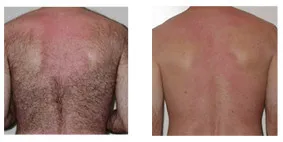 Promotion!! Permanent Hair Removal Machine 808nm Diode Laser/ Laser Diodo 808