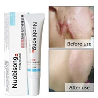 

Nuobisong Remove Scars Face Skin Care Treatment Blackhead Remove Anti Acne Cream Treatment Moisturizing Cream