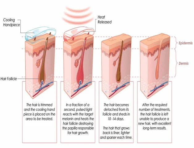Full set diode 808nm/755nm/1064nm three wavelength diode laser beauty hair remover machine for assemble by customers DIY