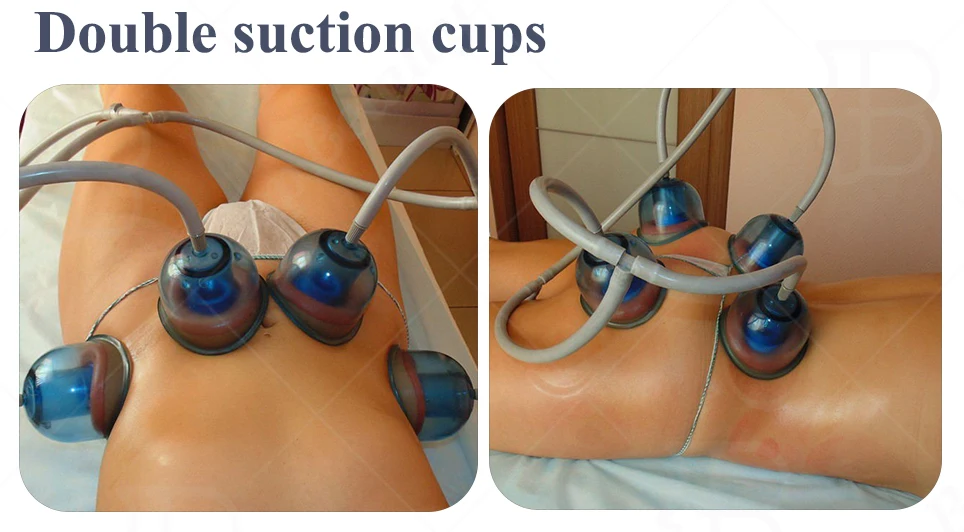 Starvac Sp2 Butt Lift 18cm Suction Vacuum Cupping Therapy Buttock