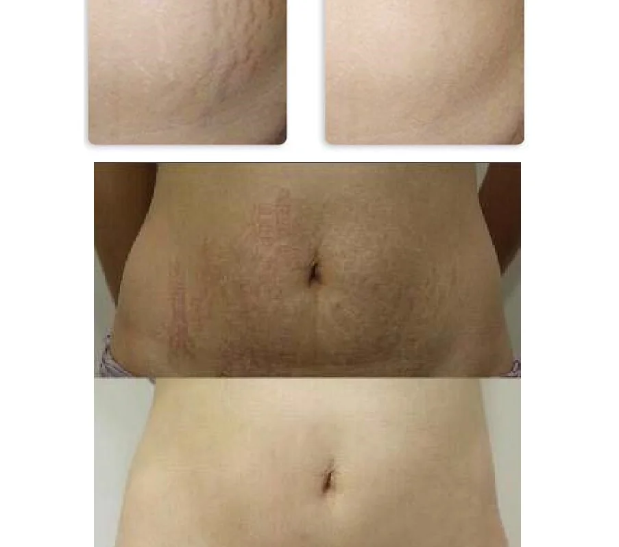 
MR19-2S Chinese Famous Manufacture Fractional RF Microneedling Machine Fractional Microneedle 