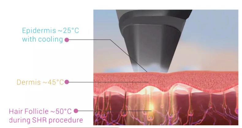 Hottest Sale Portable 808nm Diode Laser Hair Removal Machine