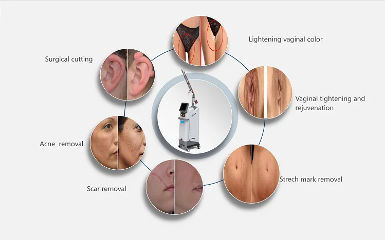 Pentagon Rf Co2 Fractional Laser With 1540nm And Free Graphics