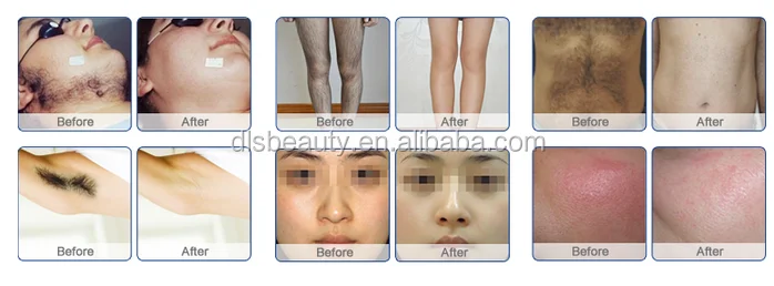 hair removal