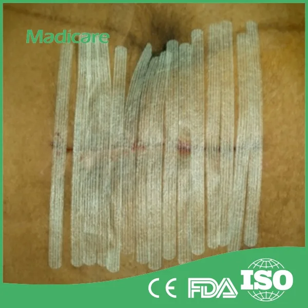 Adhesive Wound Skin Closure Tape For Surgery And Cosmetic Wound