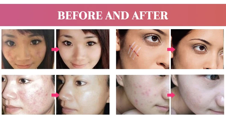 Economical portable 7 glass galvanic tubes high frequency facial machine