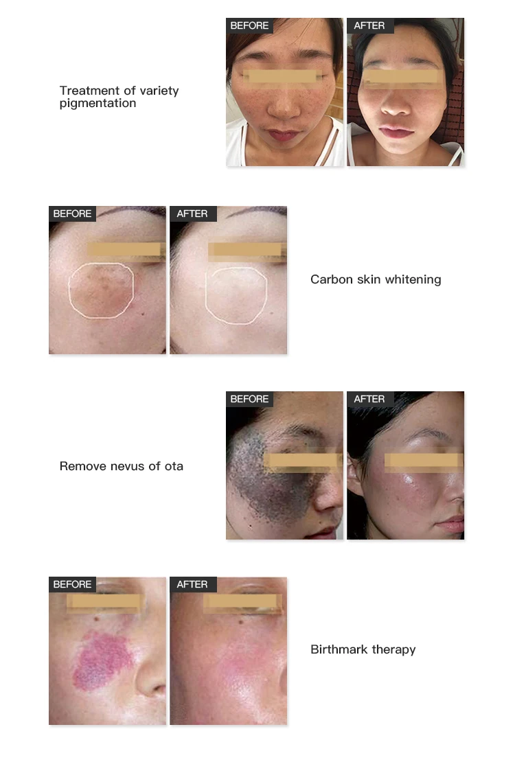 yag laser tattoo (8).jpg