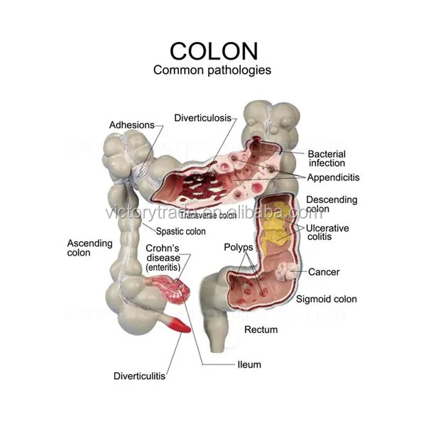 V-am049 Medical Human Pathological Colon Anatomy Model For Teaching Use