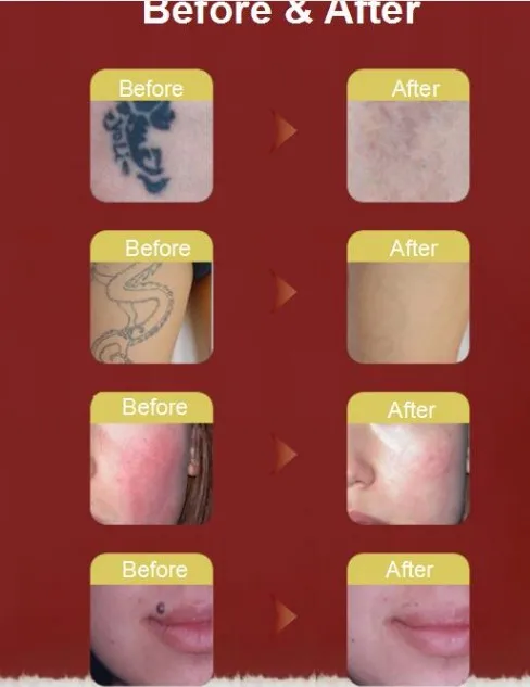 picotech .before and after