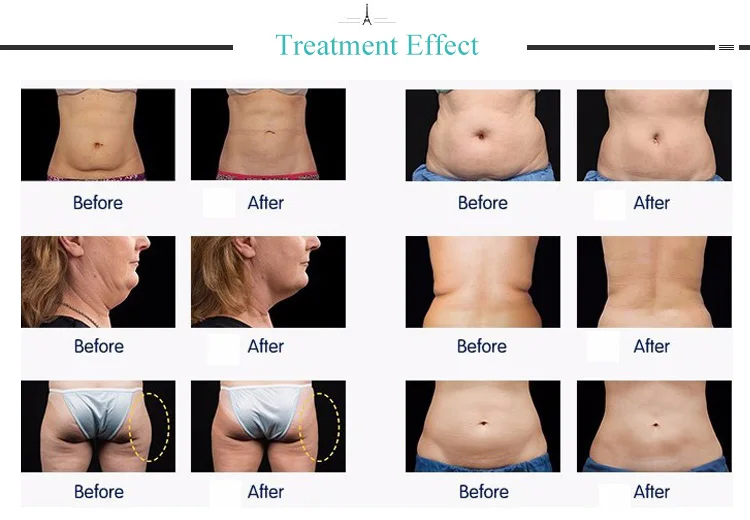 40k cavitation machine.jpg