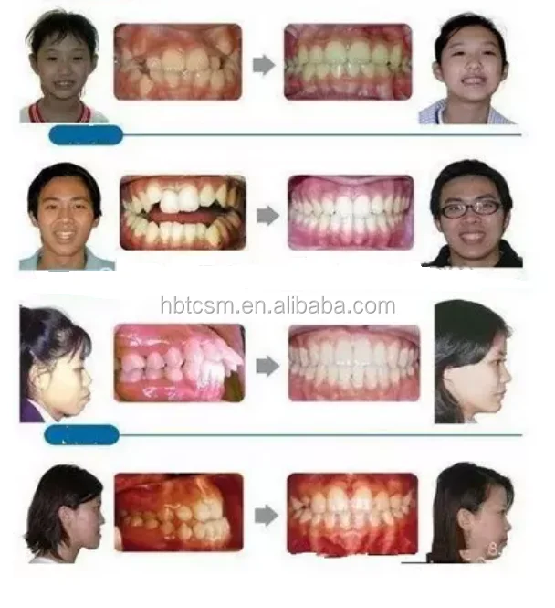 silicone teeth alignment