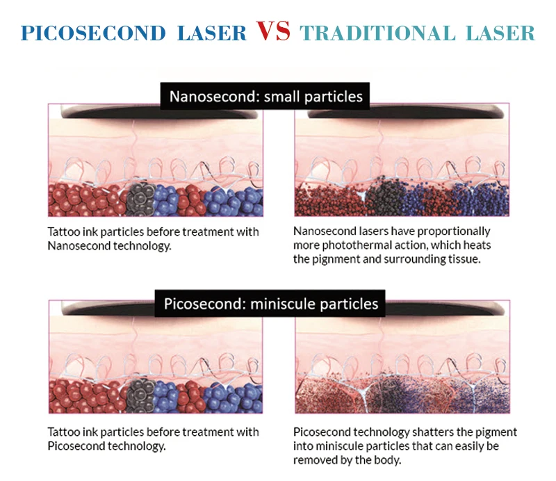 The most popular Picosecond laser ce approved machine pico laser for tattoo removal