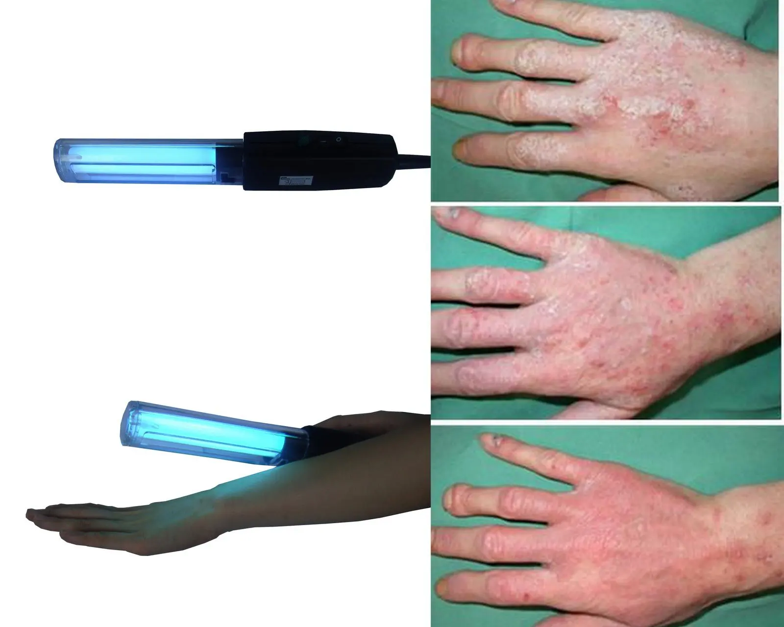 Poche UVB lampe pour VITILIGO-PSORIASIS photothérapie Poche UVB lampe pour VITILIGO-PSORIASIS photothérapie