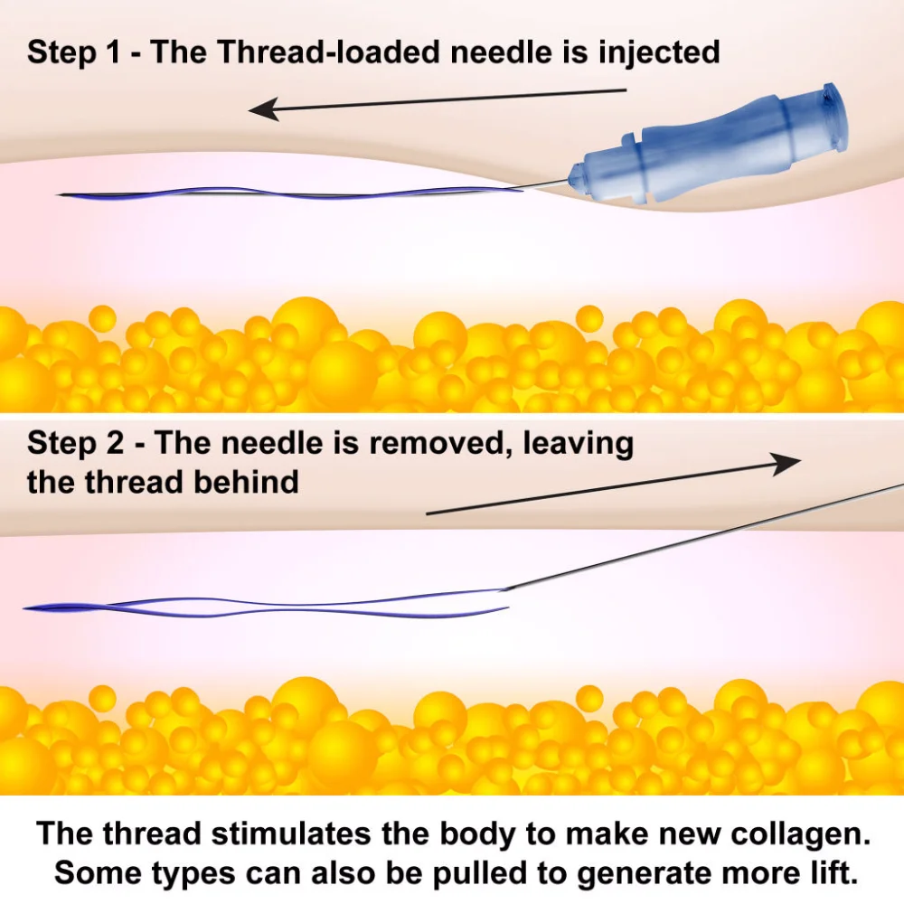 81 thread. 81 thread