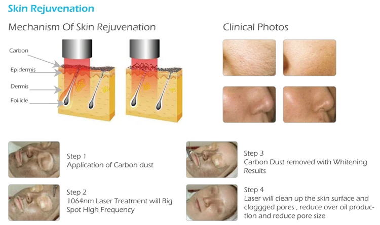 Professional Tattoo Removal Picosecond Laser Tattoo Removal Machine For