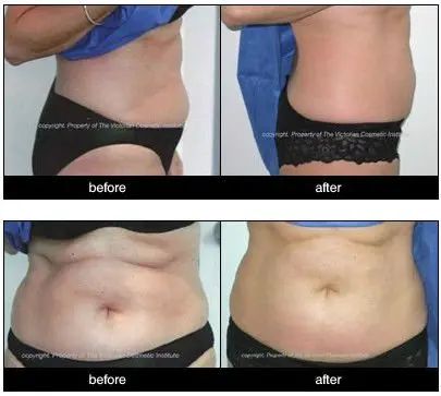 cavitation RF infrared arm slimming machine for skin tightening with CE