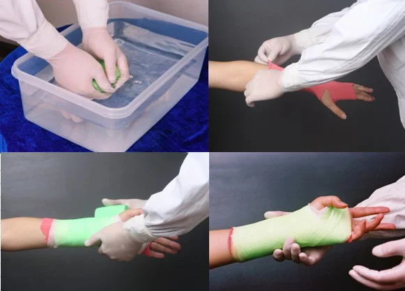 plaster bandage hand casting