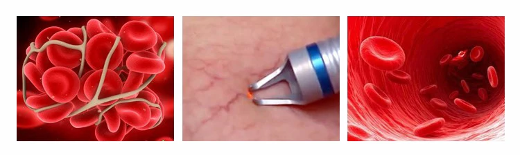 Portable 980nm diode laser vascular therapy machine / red blood vessels spider vein removal 980 nm