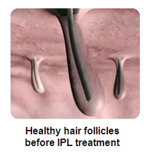 IPL SHR /SHR IPL /IPL hair removal, professional laser hair removal machine