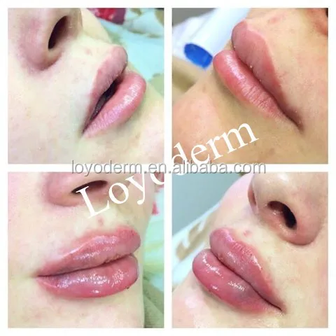 

Loyoderm hyaluronic acid injectable dermal filler for lip filler DERM 2.0ML, Transparent