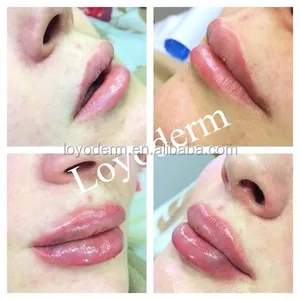 Loyoderm hyaluronic acid injectable dermal filler for lip filler DERM 2.0ML