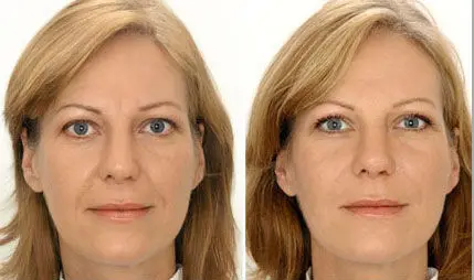 bio face lift device