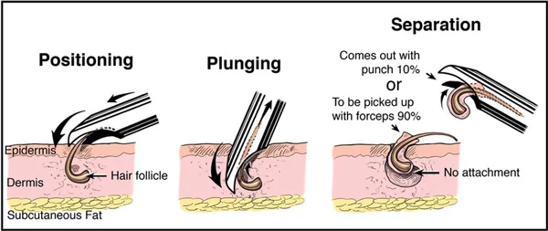 
Hair removal needle tube/hair follicle extraction needle/hair transplantation ring drill for FUE hair transplantation 