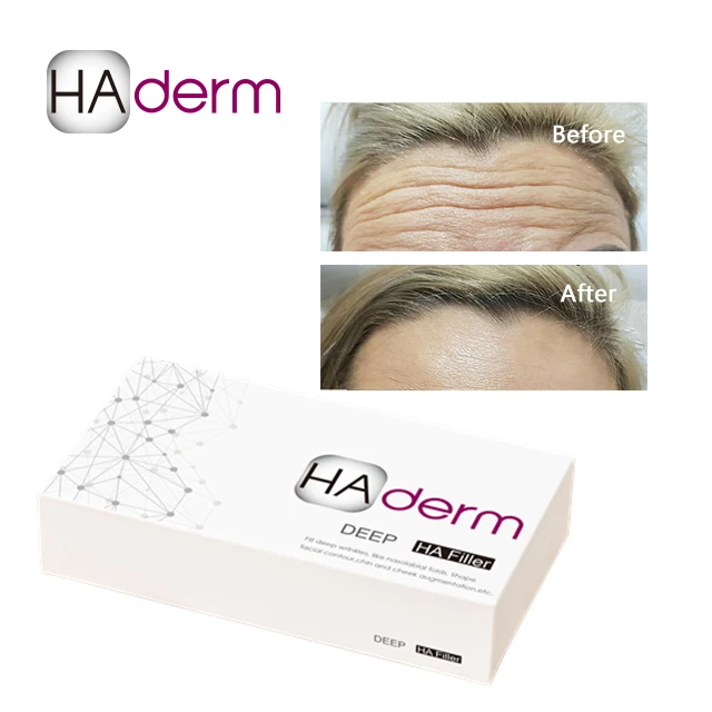 
Injectable Hyaluronic Acid full lips beauty lips 