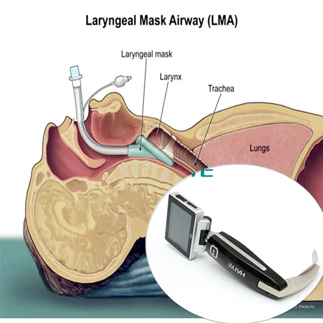 indirect ent throat scope epiglottis video laryngoscope
