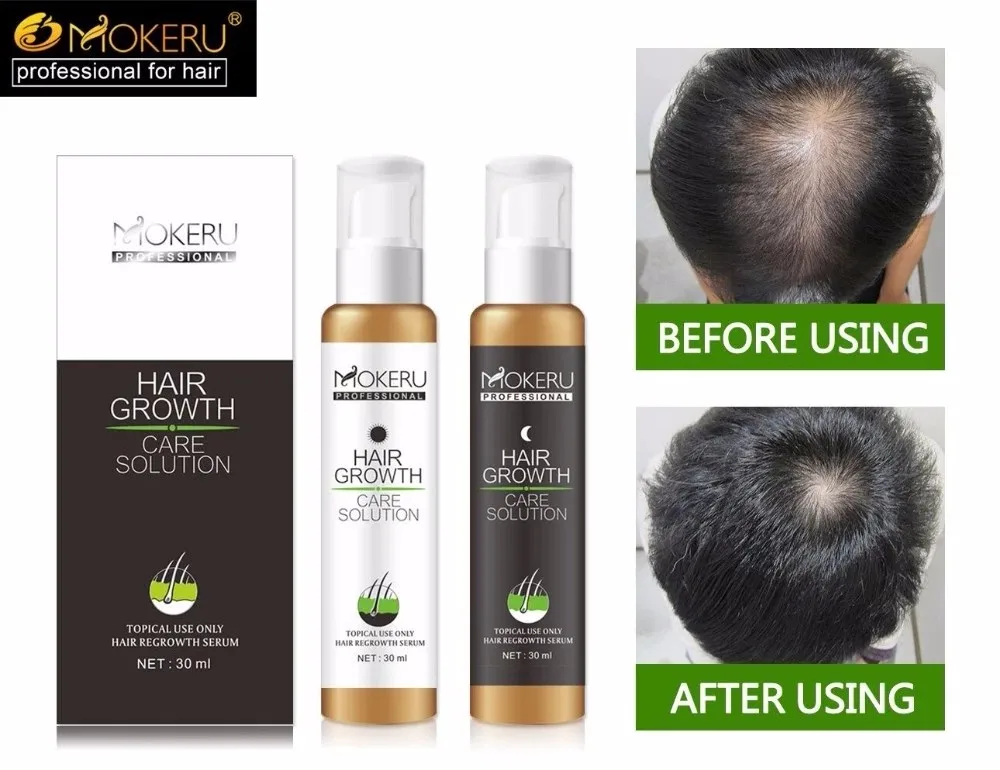 Best Anti Hair Loss/aging Treatment Growth Lotion For Female And Men