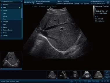 
High-quality Portable Ultrasound machine Mindray DP-50 with Diagnostic Ultrasound system for hospital 