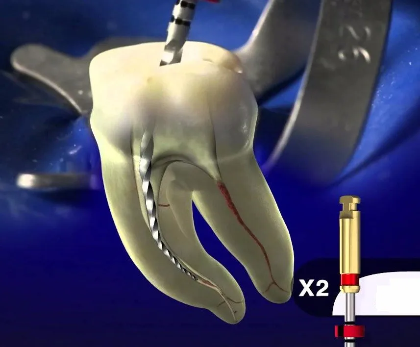 Niti Root Canal Files Similar As Protaper Next Endo Files For Dental