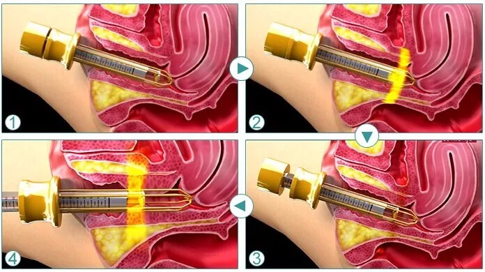 all industries  beauty & personal care  beauty equipment  laser