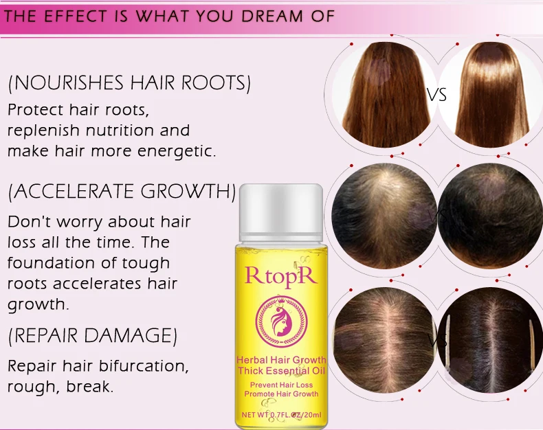 Hair Loss Prevention Treatment For Men Women With Thinning Hair