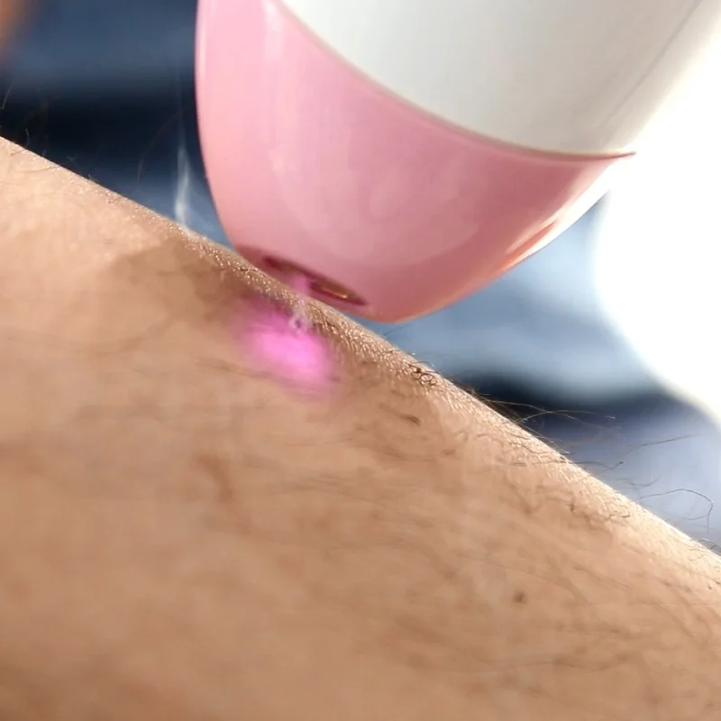 

Laser diode hair removal handheld laser hair removal home portable hair laser removal at home