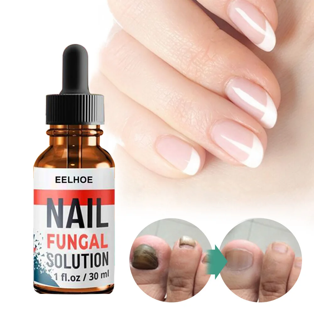 

eelhoe Fungal Nail Repair Essence Serum Care Treatment Foot Nail Fungus Removal Gel Anti Infection Paronychia Onychomycosis care