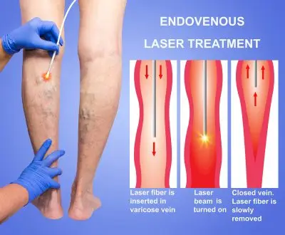 Endovenous Laser Treatment