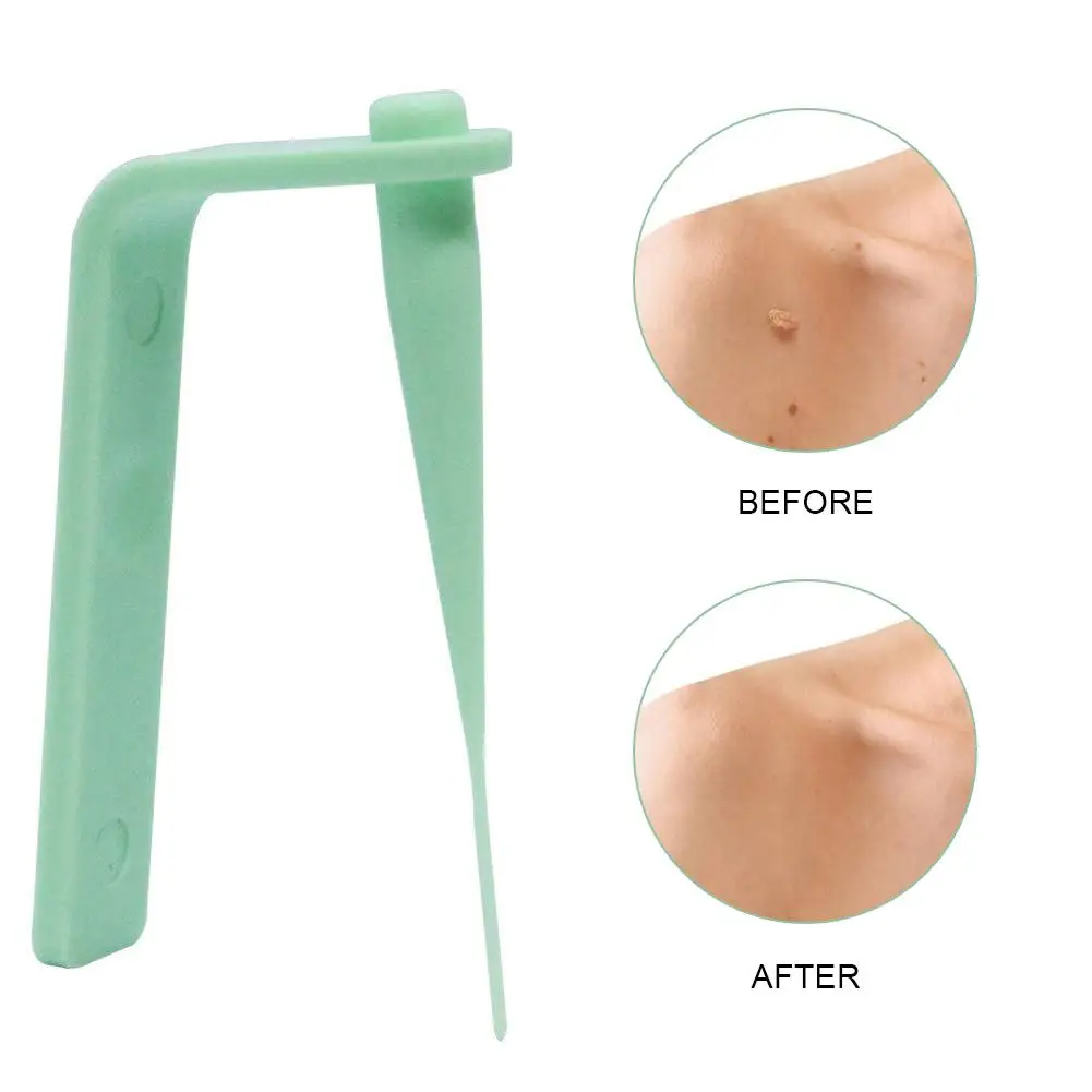 

Small Medium Body Face Tags Removal Kit Cleansing Wart Skin Tag Remover, Green
