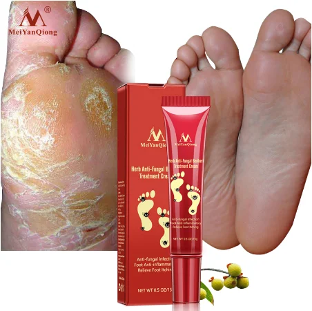 

Effective Foot Treatment Anti Fungal Infection Onychomycosis Paronychia Toe Fungus Treatment Feet Repair Cream Foot Care