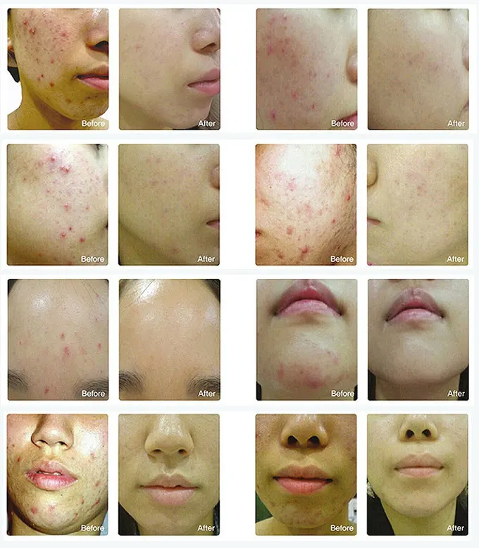 7 种颜色 jelys 与 ce 机器 led 面膜皮肤美白 led灯治疗美容设备