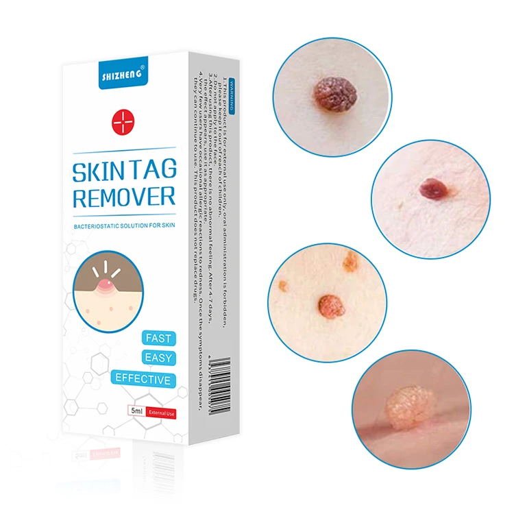 

freedelivery freeze away corn and wart removal skin tag mole wart remover nails fungus anti-corns and foot warts care pen liquid
