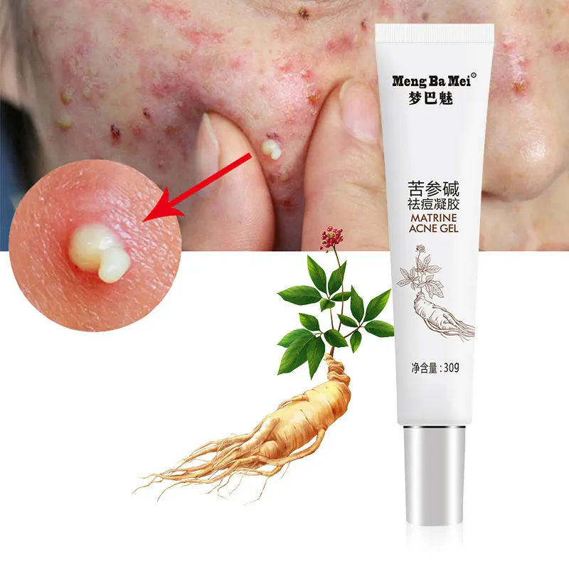 

Custom Label Acne Treatment Cream Repairing Acne Face Cream Natural Facial Gel