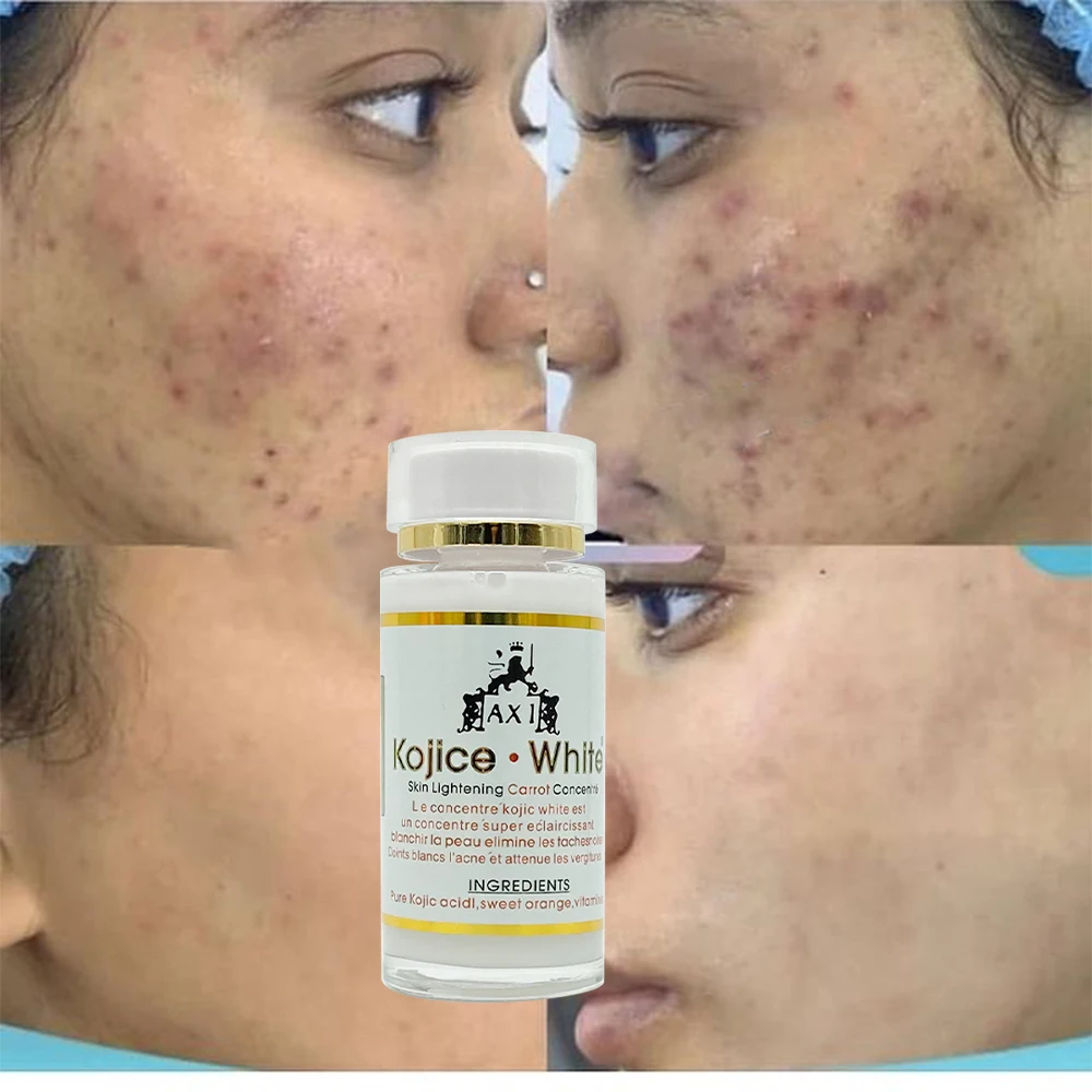 

Concentre Kojic White Lightening Serum with Vitamines C Acne Treatment Remove Dark Spots & Pimples for Anti-Aging Skincare Serum