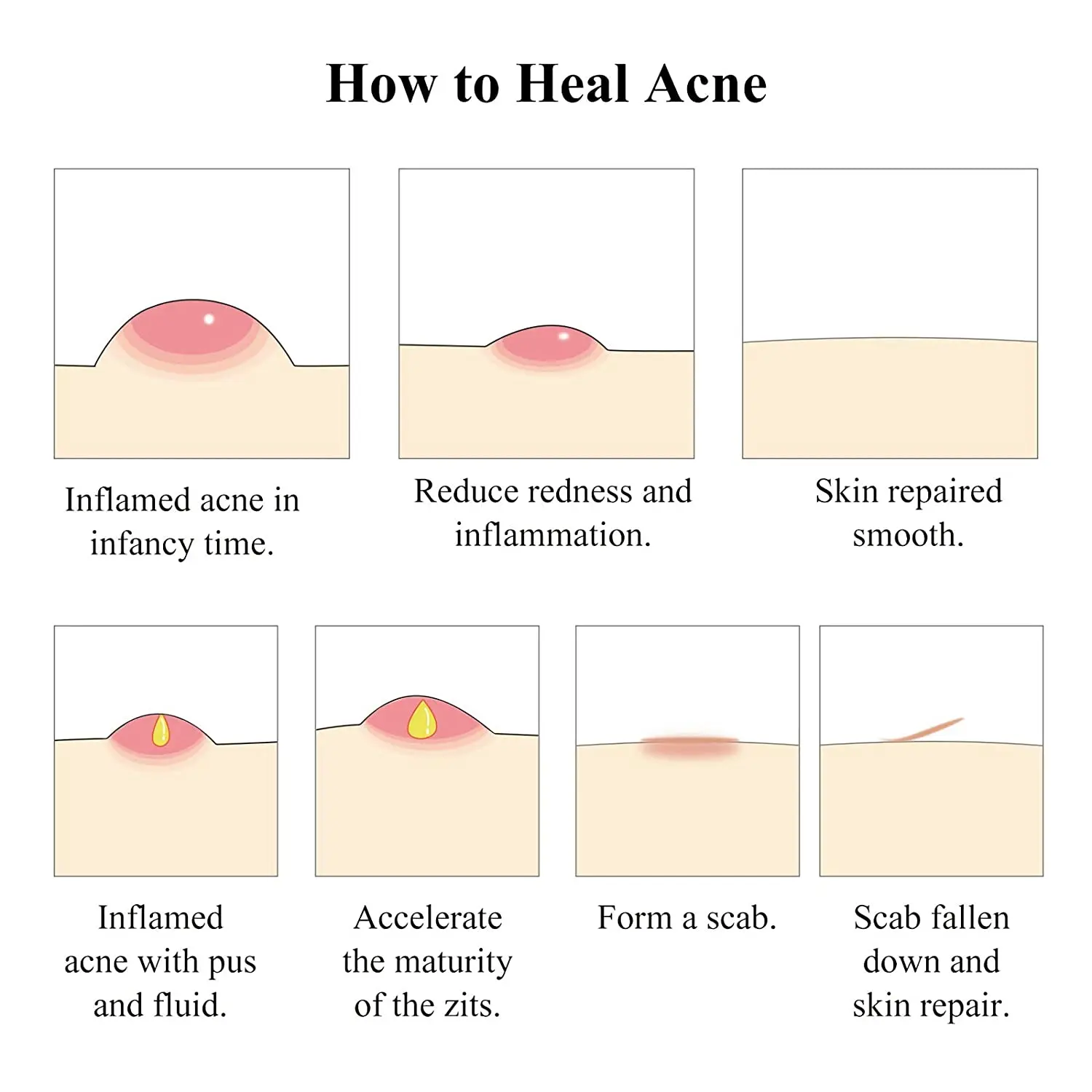 
Private Label Face Skin Care Remove Pimple And Repair Skin Tea Tree Oil Acne Treatment Cream 