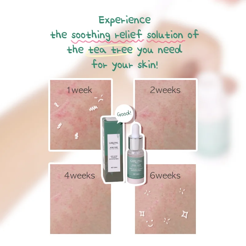 

Best Seller Teatree Serum Anti Acne Repair Scar Removal Face Beauty Anti- Acne Shrink Pores Serum