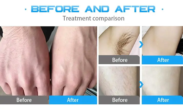 4 in 1 808 diode laser hair removal + Elight skin rejuvenation + ND YAG laser tattoo removal + RF slimming machine