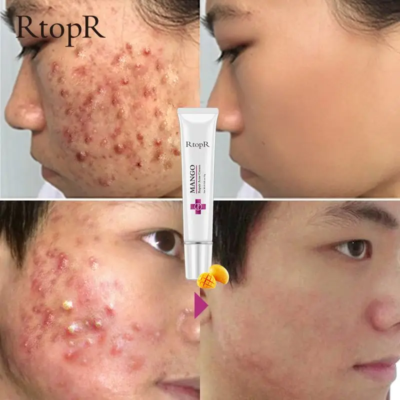 

New Anti Acne Moisturizing Gel cream Oil Control Shrink Pores oily skin Acne Spots Face skin care repairing Shrink Pores